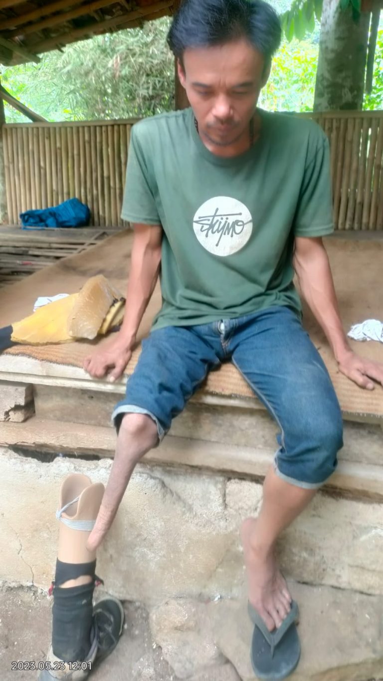 Ingin Lakukan Aktivitas, Warga Cijeruk Butuh Kaki Palsu