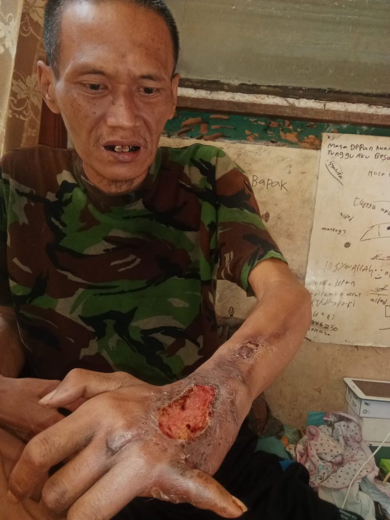 Tidak Bisa Bekerja, Warga Ciherang Kidul Butuh Bantuan Setelah Idap Penyakit Gula